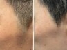 ◎17時まで限定【メンズ脱毛】★初回お試し★もみあげ￥3300