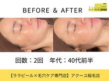 ア クーユ 稲毛店/レモンボトル/二重あご/小顔