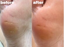 サゥオルサロン(sawalsalon)/角質フットケア症例