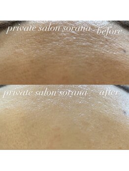 ソラナ(sorana)/40代からのフェイシャルWAX脱毛