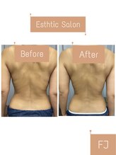 FJ/セル脂肪◇痩身