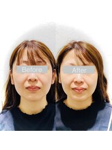 ワカヤマ 小顔(Wakayama)/★Before・After★