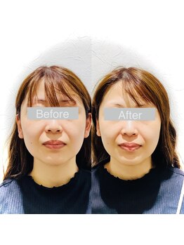 ワカヤマ 小顔(Wakayama)/★Before・After★