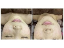 ハッテンビューティーパーク 神戸店(Hatten Beauty Park 810)/【ナノBirodo瞬時美白・保湿】