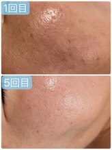 サロンドエテ(salon de ete)/肌荒れ凸凹肌も滑らか美肌