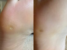 メグムサロン(Megumu Salon)/足つぼ/角質/マッサージ