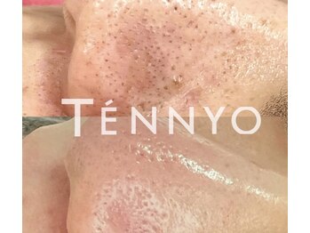 オリ('OLI)/ハイドラ毛穴洗浄