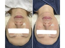 クロッシュ(Cloche)/ジュエリーピール＋光フォト