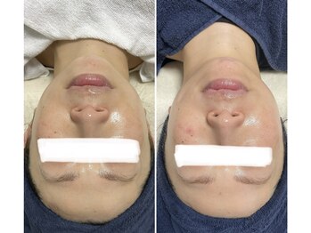 クロッシュ(Cloche)/ジュエリーピール＋光フォト