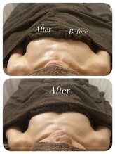 ワンバイゼロ(One by zero)/ボンボンバストbefore→after