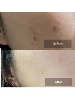 ルシェルブルー(Le ciel bleu)/シミケアにも♪