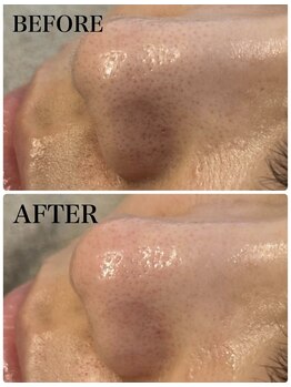 アンドエルビオ(&Elbio)/毛穴洗浄