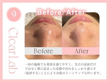 クリアラボ 池袋2nd(Clear Lab)/韓国肌管理&毛穴洗浄専門店
