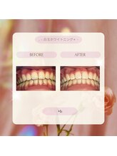 プラスビー 2号店(+b)/ホワイトニングビフォーアフター
