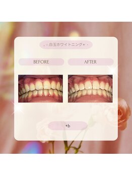 プラスビー 2号店(+b)/ホワイトニングビフォーアフター