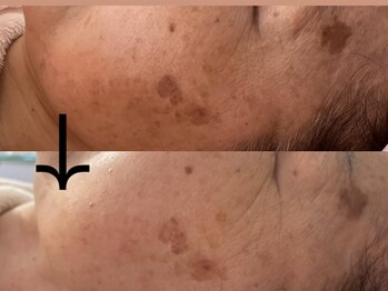 サロン ドロップ 上小田井(Salon drop)/「シミ改善」途中経過