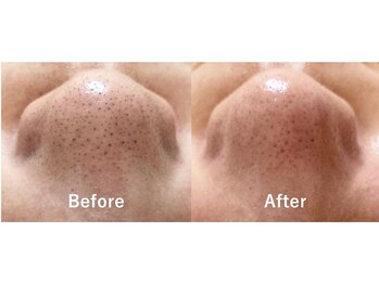 アリス(Alice)の写真/ハイドロピーリング◎気になる毛穴の黒ずみ、汚れに☆水素水毛穴を浮かせ吸い込みですっきり♪