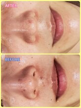 マニル アンド ネトラ(manil & netola)/肌荒れ跡が改善！