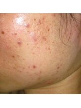 レプス(Lepus)/ハーブピーリングハード(3～5日)