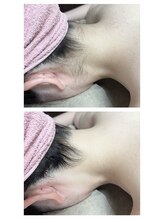 サロンドジェシカ(salon de Jessica)/うなじ脱毛