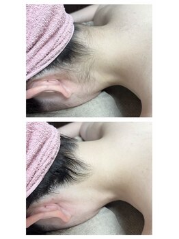 サロンドジェシカ(salon de Jessica)/うなじ脱毛