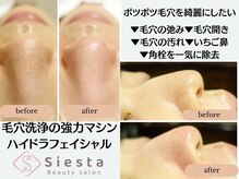 シエスタ(siesta)/ポツポツ毛穴を綺麗にしたい