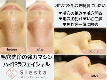 シエスタ(siesta)/ポツポツ毛穴を綺麗にしたい