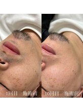 ランプ(LAMP)/～ハイブリッドヒゲ脱毛～