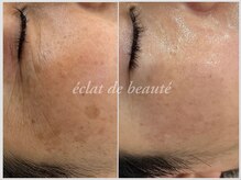 エクラデボーテ(eclat de beaute)
