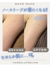 ガーオガーオ 新宿 四ツ谷(GaaoGaao)/ハーブピーリング/二の腕/3回目