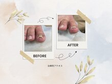 【痩身/ダイエット/整体/骨盤矯正】専門サロン アテオス/巻き爪