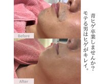 ファミーユ(famille)の雰囲気（高出力脱毛でVIOの黒ずみも改善！高出力で濃い毛も産毛にも◎）