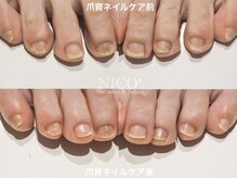 ニコプラス(NICO+)/フット爪育ネイルケア