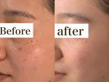 ヒール(heal)/症例