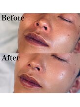 エクリア(ECLIA)/フェイシャル Before⇒After