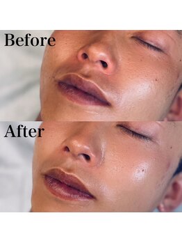 エクリア(ECLIA)/フェイシャル Before⇒After