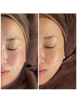 カラット(CARAT)/光フェイシャル/小顔/艶肌/美肌