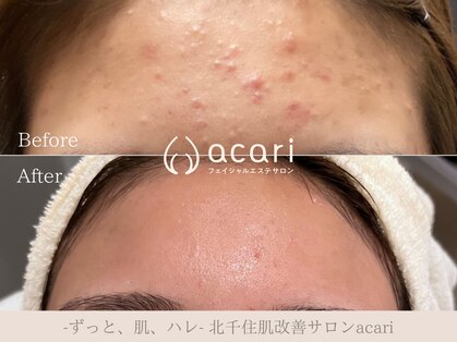アカリ(acari)の写真