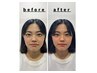 【初回限定！特別特価！】肌つや・シワ改善美容鍼　 7,000円→3,500円
