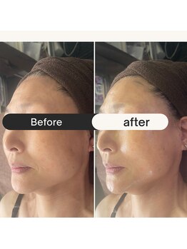 リラクゼーションサロン ラキ(laki)/ハイピールイントゥ/ピーリング