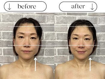 ビースタイル(B-style)/【電気美容鍼】ビフォーアフター
