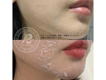 ハーバリー ハーブピーリング 岐阜(HERBERRYハーブピーリング)/ハーブピーリング専門店HERBERRY