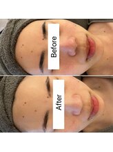 ブルームーン(Blue Moon)/REVI＆ララピール　４回施術