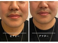 クク 赤坂 天神(99 KUKU)/むくみ除去