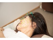 北梅田美容鍼灸院/【大阪/梅田】美容鍼灸
