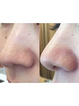 美白ケアをしたい