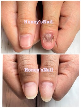 ハニーズネイル(Honey's Nail)の写真/深爪,巻き爪矯正歴10年以上の老舗店☆《深爪矯正》長さ出し+ジェル仕上げ12960円～！フット深爪13960円