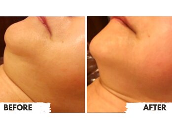 ピュールマロン ムッシュタロウ 桑名店(Pure Marron M.Taro)/二重顎たるみ改善！