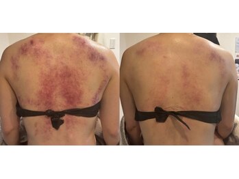 クレシア(CRECIA)/背中コルギ