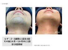 ロミオワックス ジュリエットワックス 新宿店(ROMEO Wax Juliet Wax)/髭脱毛/光脱毛ビフォーアフター